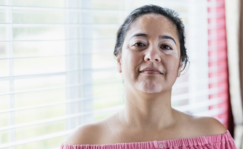 Como funciona o skincare para pele com vitiligo e qual é a importância desse cuidado